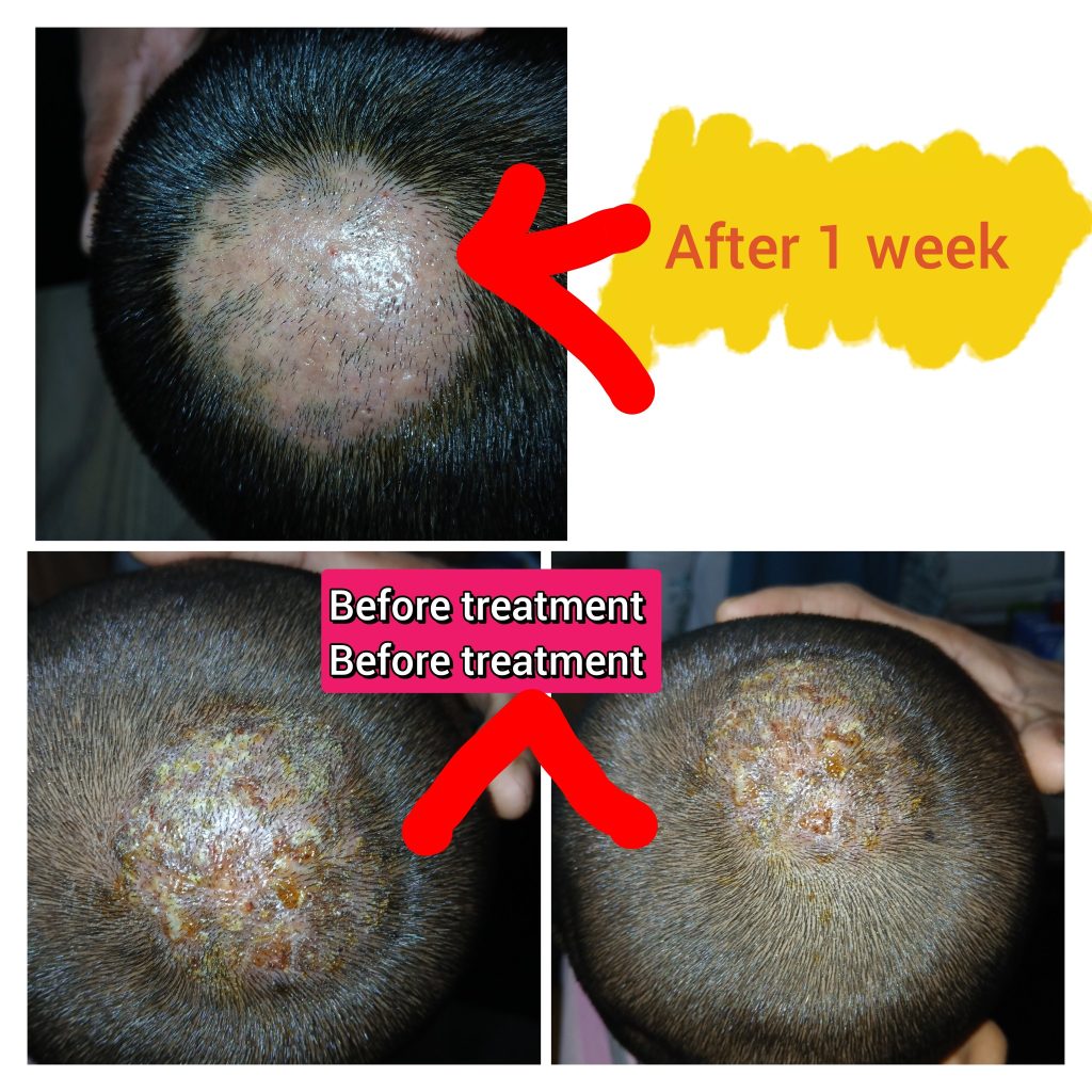 Kerion-treatment-by-dr-sabina-yeasmin-md-drmatology